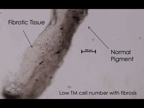 Vídeo: Resultados Refrativos Em Pacientes Com Glaucoma Submetidos à Extração De Catarata Por Facoemulsificação Com E Sem Goniotomia Kahook Dual Blade