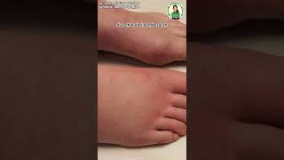 Penyebab kaki bengkak setelah melahirkan #shorts