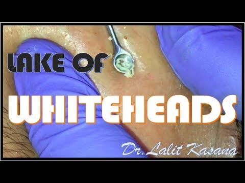 LAKE OF WHITEHEADS/ COMEDONE EXTRACTION/ ANTI ACNE TREATMENT