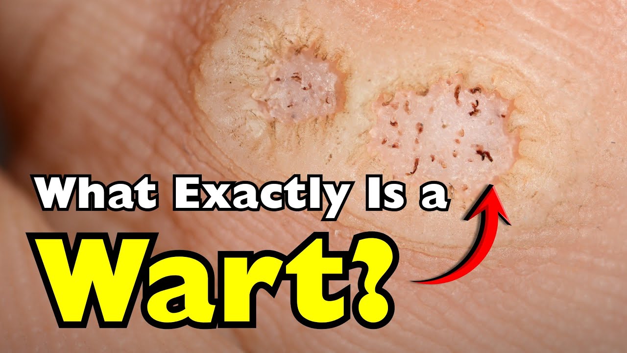 What Exactly Is a Wart—and How Do You Get One? [ID1305] - YouTube
