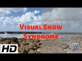 Visual snow syndrome  everything you need to know