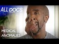 My Brand New Face - Neurofibromatosis | Extraordinary People Documentary | Documental