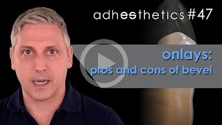 🇬🇧 Onlays: pros and cons of bevel_short#47_Adhesthetics Protocols