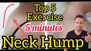 5 Best Exercise to Get Rid of Neck Hump Just in 5 Minutes at Home ( Hindi / English )