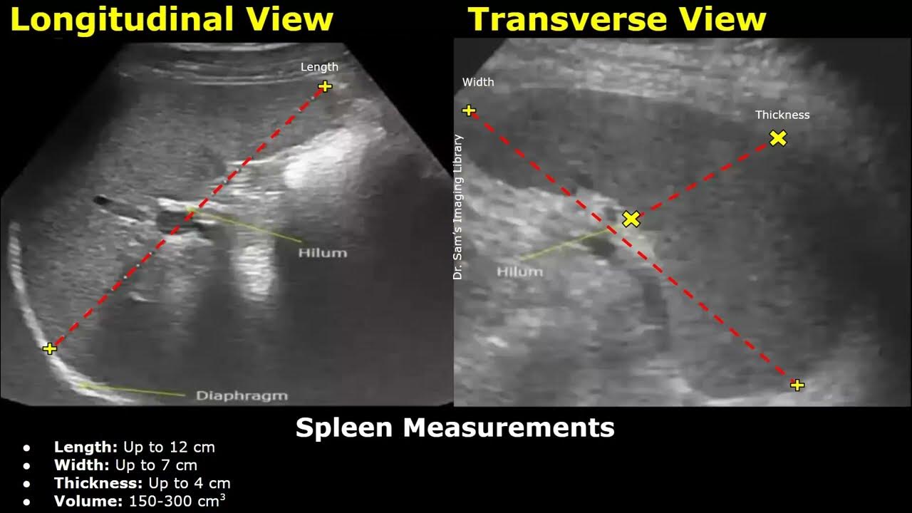 How to measure the spleen on ultrasound splenic length width