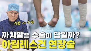 사지연장술 후 까치발은 수술이 답일까? 아킬레스건 연장술 [사지연장술] [사지연장술][키수술]