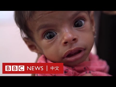 也門大量兒童營養不良 3歲小孩僅重5公斤－ BBC News 中文