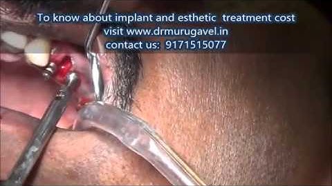 Painless extraction of premolar teeth and immediate implant in india
