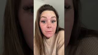 Ignore my acne, work in progress – but botox and dysport got me froze #fyp