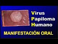 MANIFESTACIONES ORALES 𝐃𝐄𝐋 VIRUS 𝐃𝐄𝐋 PAPILOMA HUMANO (VPH)