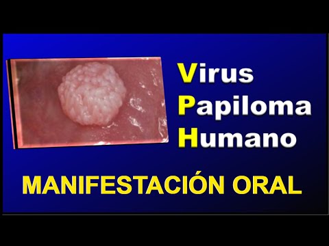 MANIFESTAZIONI ORALI DI PAPILOMA UMANO VIRUS (HPV)