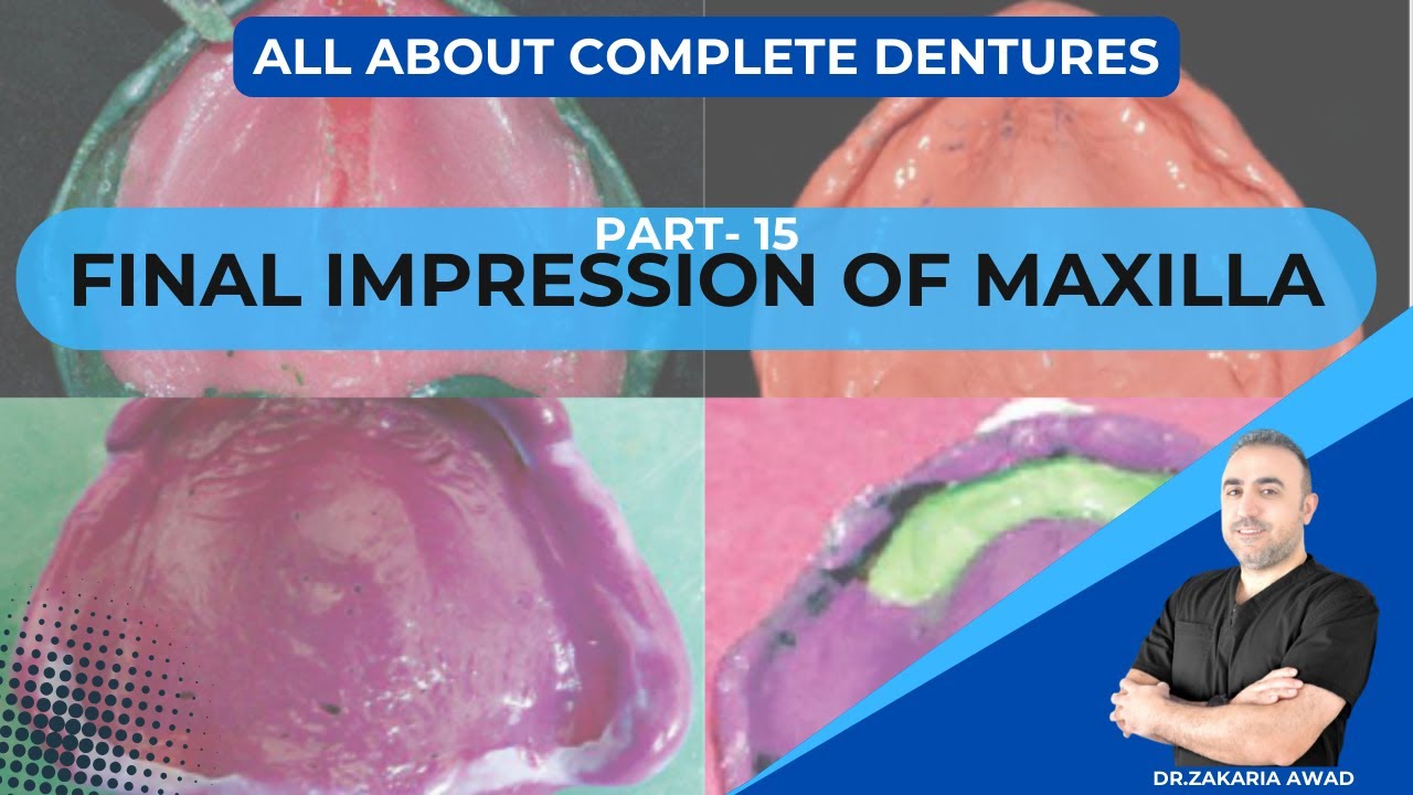 15- الطبعة النهائية للأجهزة الكاملة  العلوية - FINAL IMPRESSION OF UPPER DENTURES