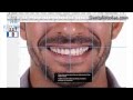 Dsd  digital smile design by felipe miguel