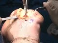 Advance Medial Pivot TKR Surgery