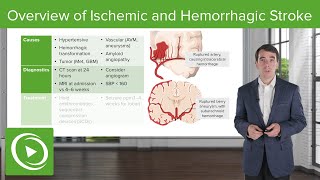 Overview of Ischemic and Hemorrhagic Stroke | Clinical Neurology