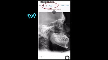 Introducing AI based automatic landmark identification