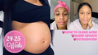 HOW TO GET RID OF ACNE!!! Pregnancy update | Vlogmas Day 4