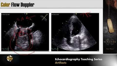 Lecture 14 - Evaluation of Prosthetic Valves