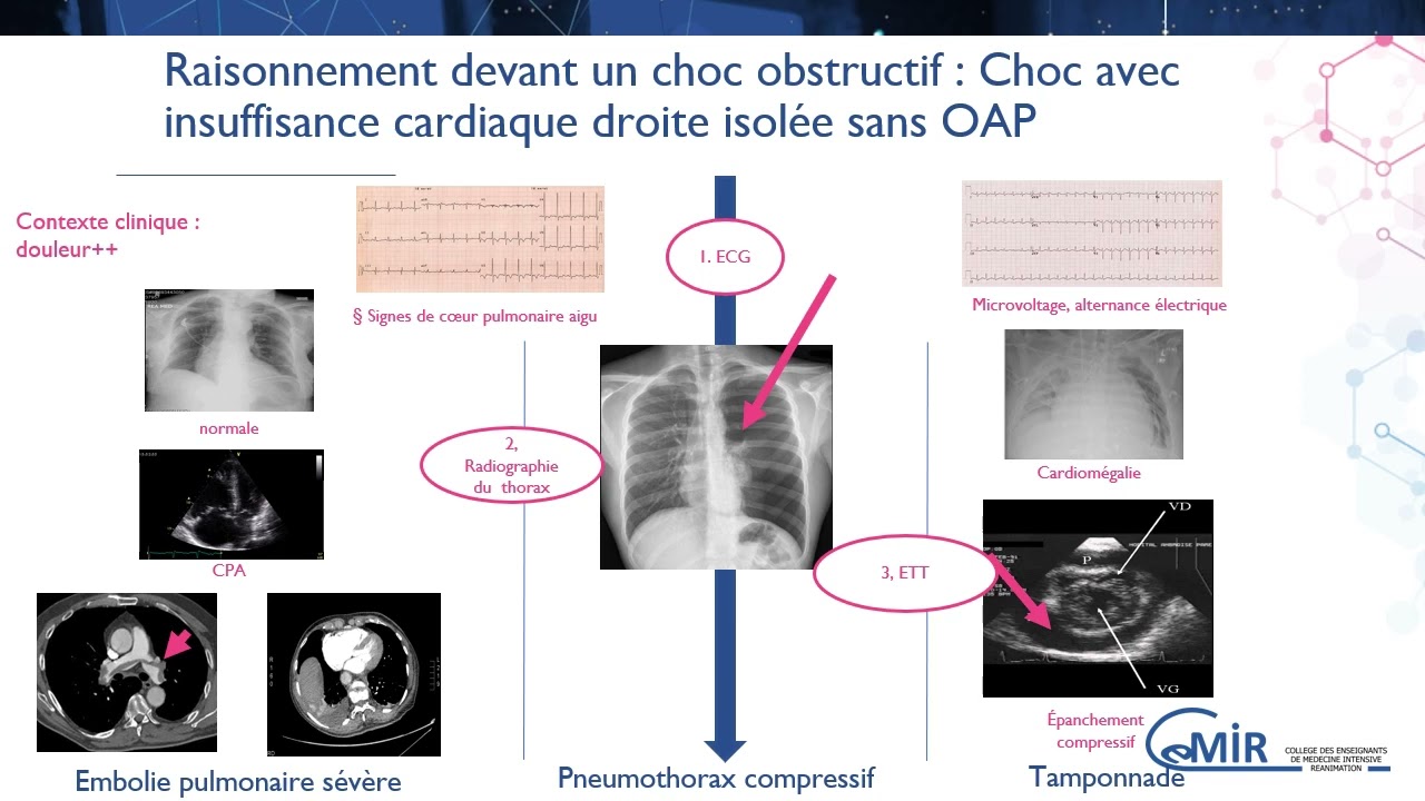 3 10 1 Choc obstructif