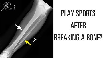 When can you play sports after breaking a bone?