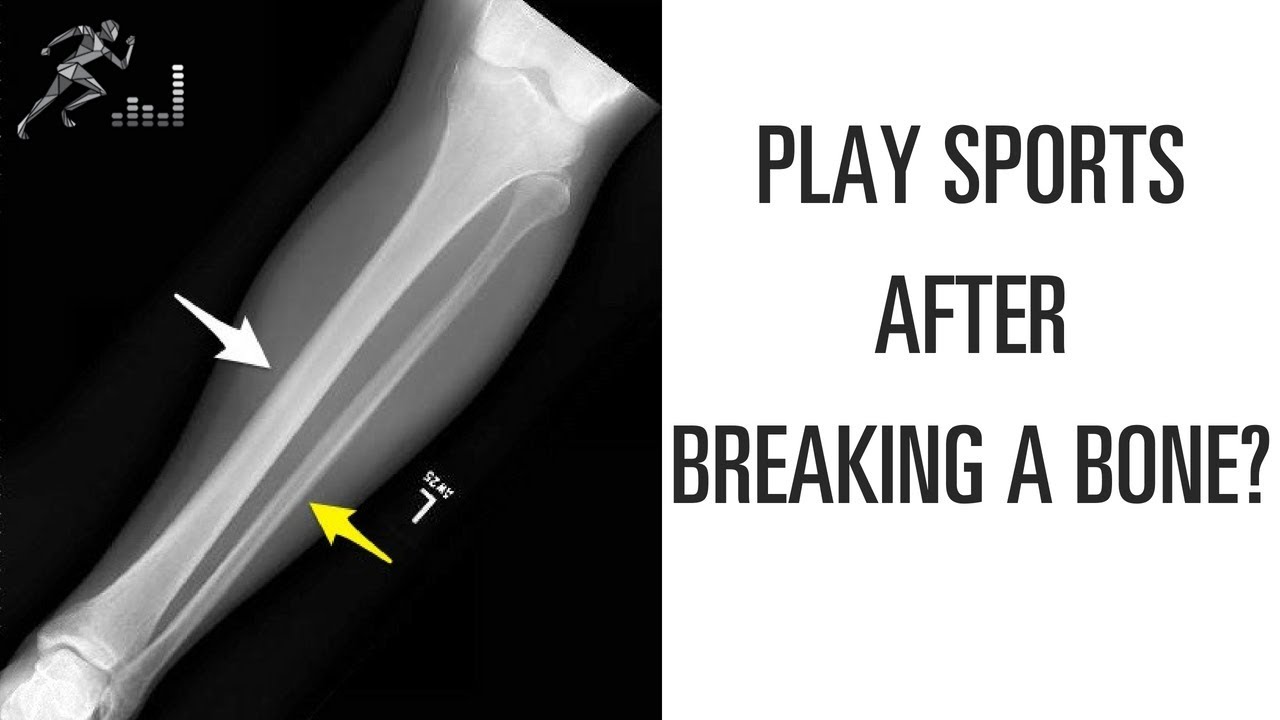 When Can You Play Sports After Breaking A Bone YouTube When Can You Play Sports After Breaking A Bone YouTube