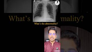 What’s the abnormality in Xray? #pulmonology #radiology #icu