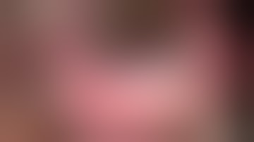 Xen Gel Stent Ab Interno Technique