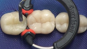 3M ESPE Filtek - Composite Restoration using Bulk Fill Technique PinkBlue.in