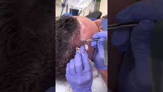 A Quick Look At What Hair Transplant Surgery Day Looks Like!