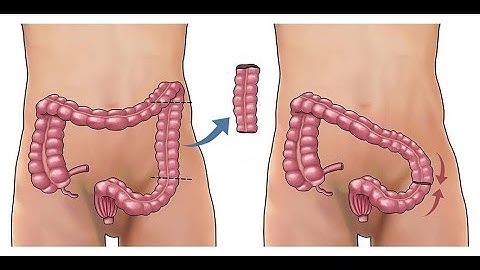 Sigmoid colectomy CPT code - simplify medical coding