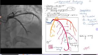 Coronary Angiogram. Myocardial Bridging.