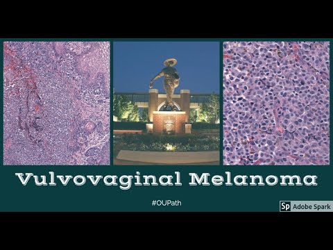 Digital Pathology Sign out 41 Vulvovaginal Melanoma