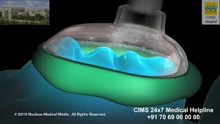 Dilation and Curettage (D & C) – CIMS Hospital