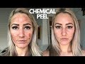 Chemical Peel On Sensitive Skin (NEVER AGAIN!!!)