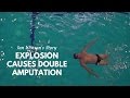 Explosion Causes Double Amputation