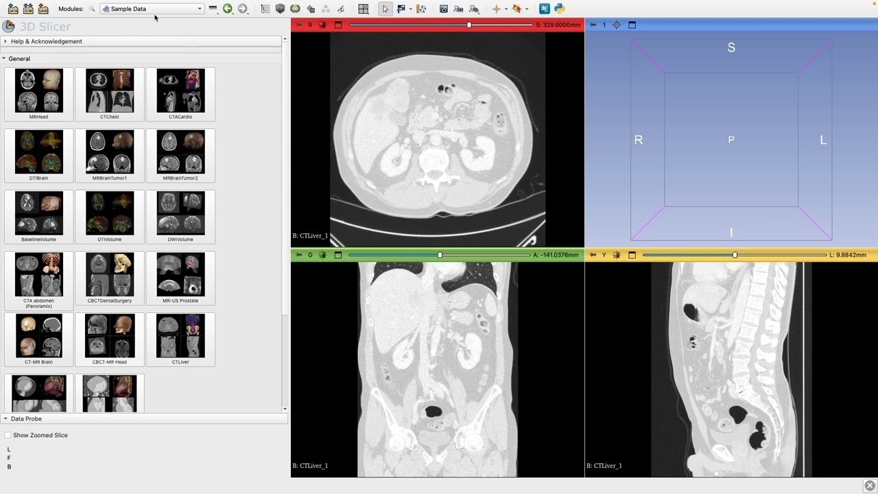 CT Window Presets: Bone, Lung, and Soft Tissue | 3D Slicer