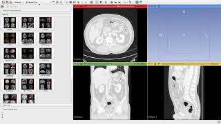 CT Window Presets: Bone, Lung, and Soft Tissue | 3D Slicer screenshot 5