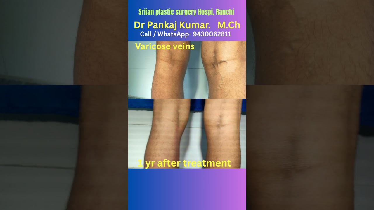 varicose veins treatment in Ranchi| Foam sclerotherapy treatment of varicose veins #varicosevein