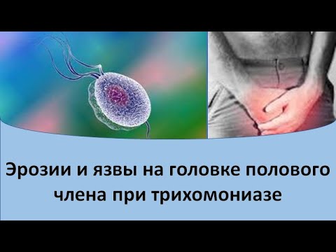 Эрозии и язвы на головке полового члена при трихомониазе