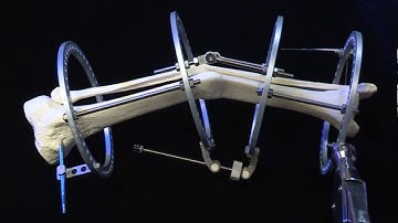 Ilizarov frame application for uniplanar deformity correction