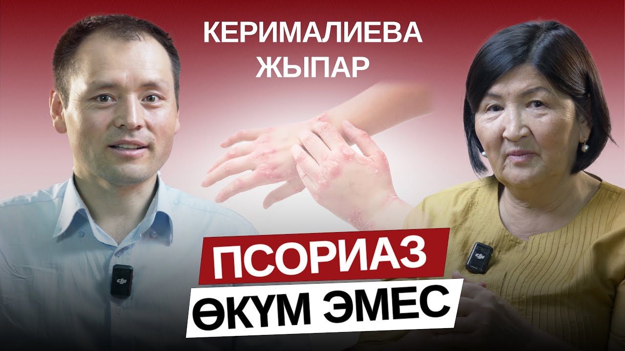 Псориаз өкүм эмес!