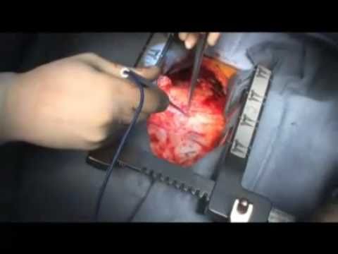 Aortivc Valve Replacement Surgery