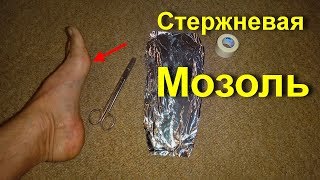 Шипица - подошвенная мозоль со стержнем. Как лечить мозоли. Все это сгинет на нет навсегда от фольги Шипица - подошвенная мозоль со стержнем. Как лечить мозоли. Все это сгинет на нет навсегда от фольги