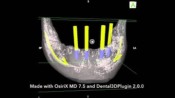Dental3DPlugin 2.0 : 3D Surface Rendering Detail