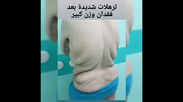 شد ترهلات الظهر العلوي بعد فقدان وزن كبير جدا 