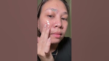 Using the Skin1004 Centella Brightening Ampoule consistently for a week 🔥 #acnetreatment