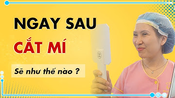Review Cắt Mí Ngay Sau Làm | Cắt Mí Có Đau Không? | Bác Sỹ Tuấn Dương