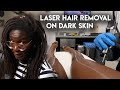My Laser Hair Removal Experience as a Dark Skin Woman // LaserAway
