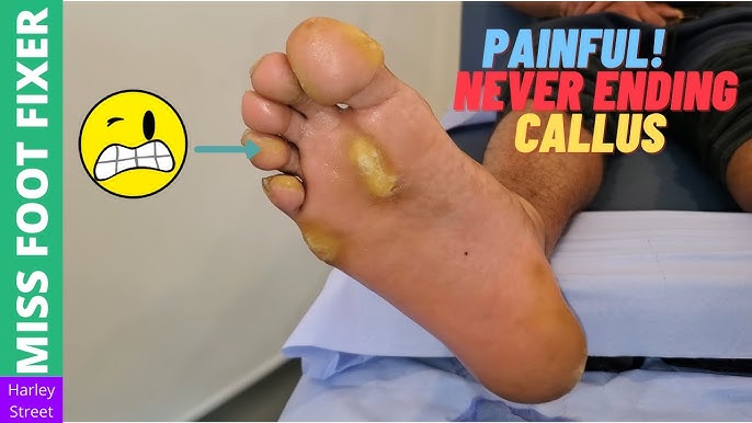 This Foot Callus Removal  Channel Is Equally Disgusting and  Satisfying to Watch
