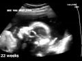 22 weeks pregnant (ultrasound sonogram)